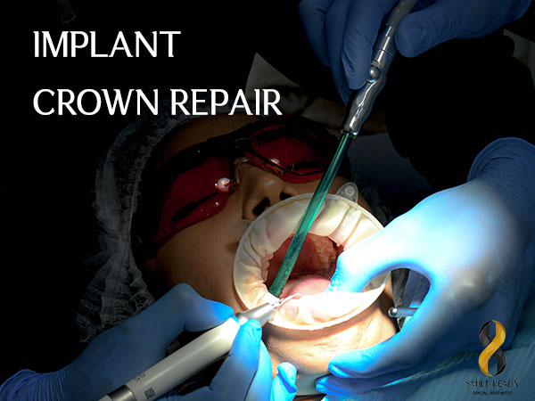 When To See A Dentist For Implant Crown Repair?