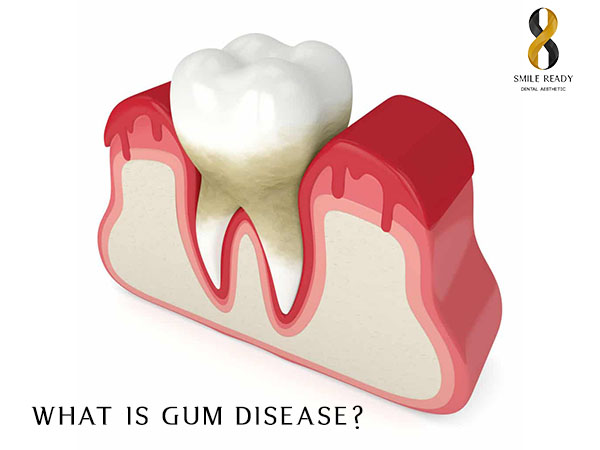 <strong>What Is Gum Disease?</strong>