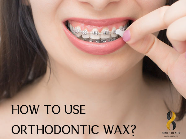 <strong>How To Use Orthodontic Wax?</strong>