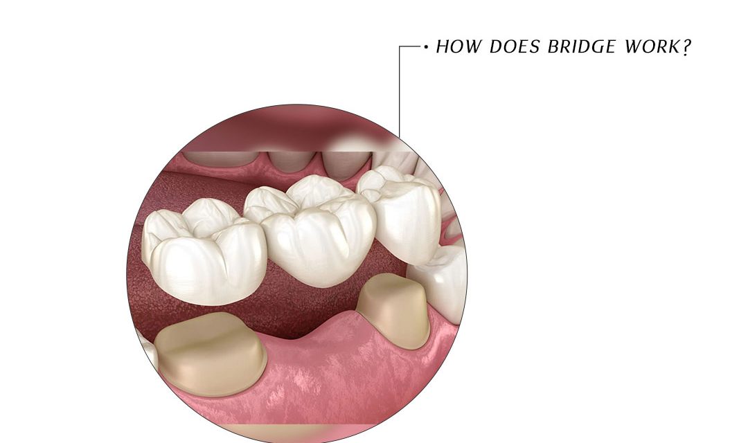 What happens during a dental bridge procedure?