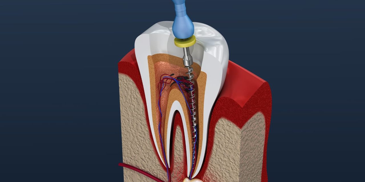 Exploring the Facts and Myths of Root Canal Treatment