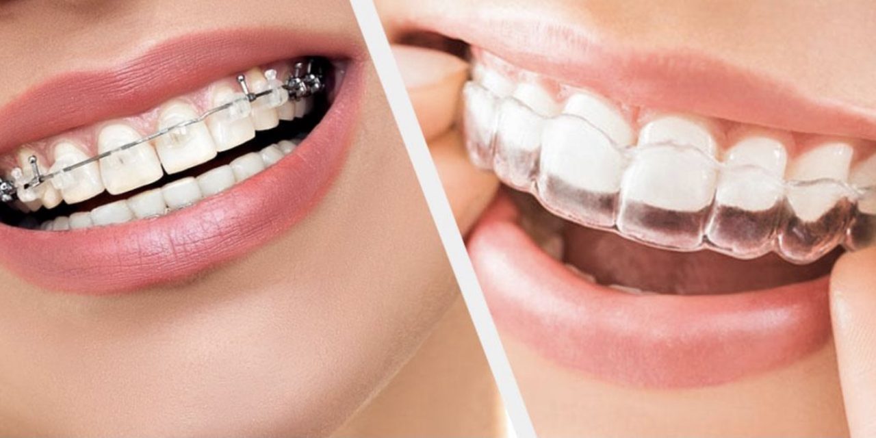 Exploring Your Options: A Comprehensive Guide to Orthodontic Treatments