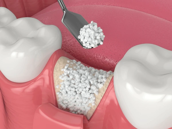 Unlocking the Potential: Understanding Bone Grafting for Dental Implants