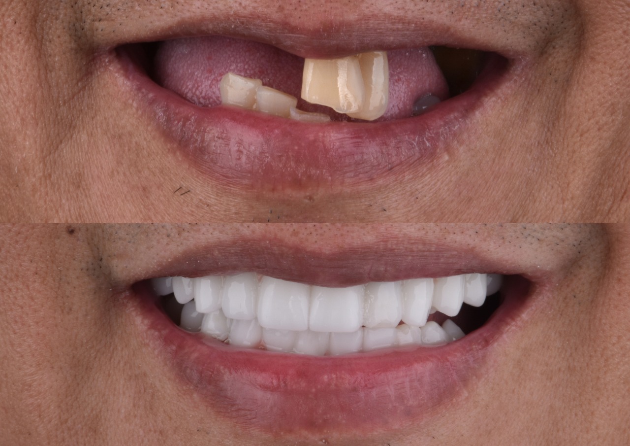 All on X Full Arch Solutions