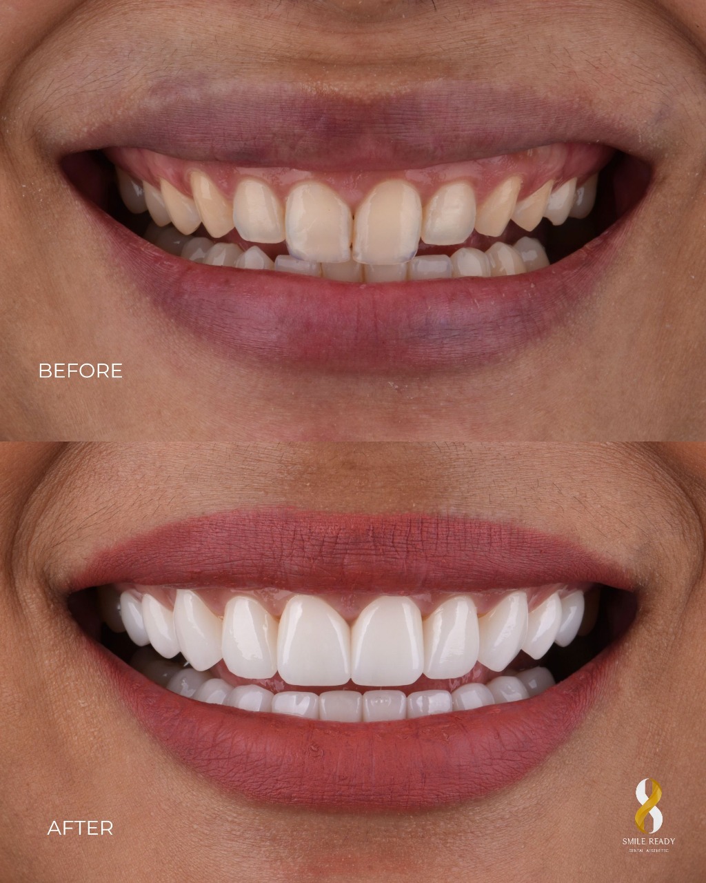 Full Mouth Treatment Result