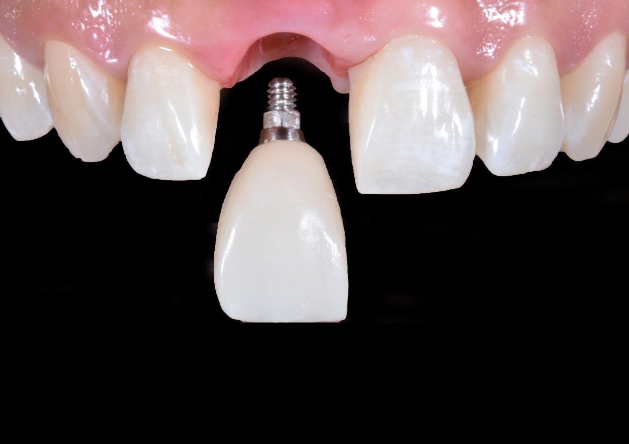 Dental Implants and Crowns