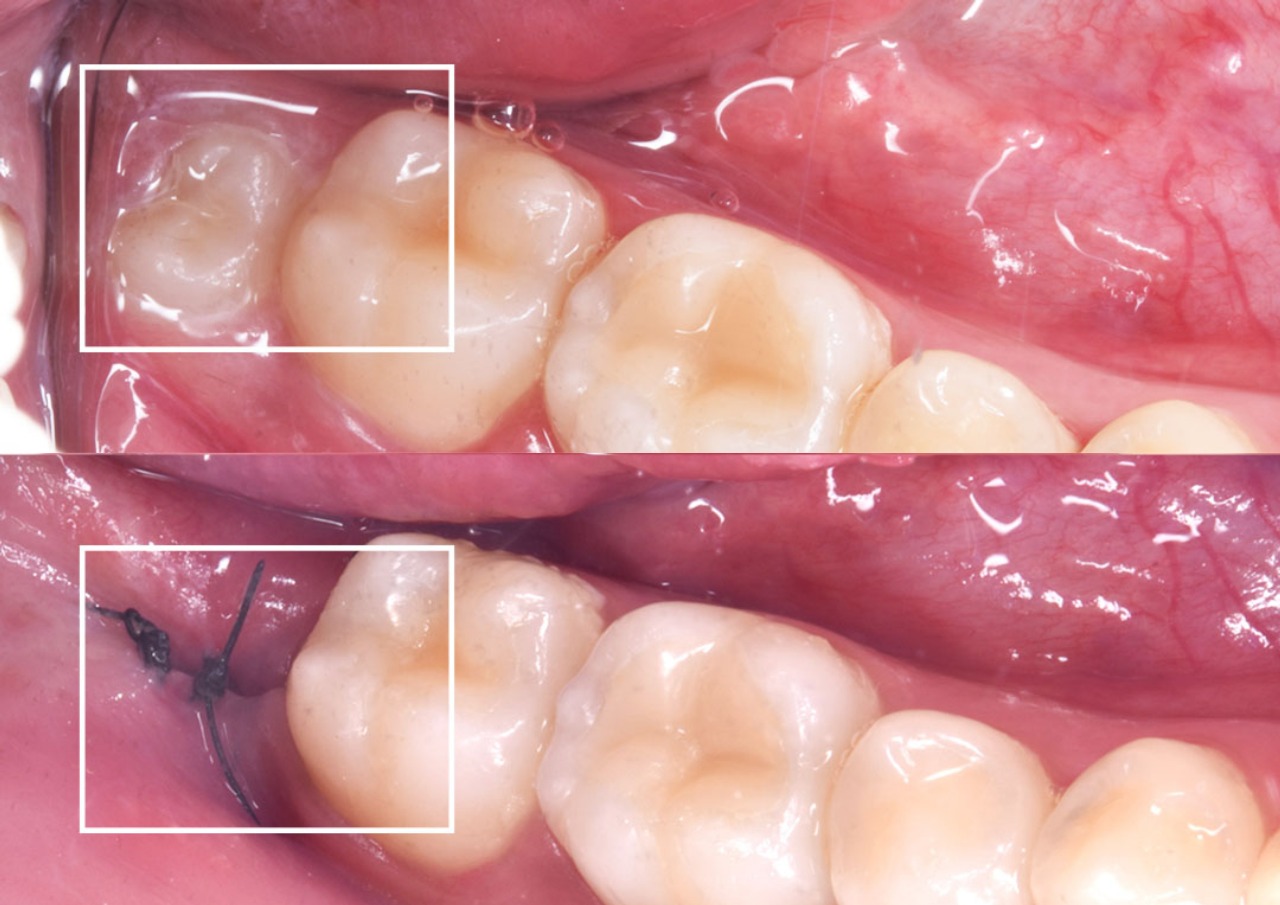 Oral Surgery and Extractions
