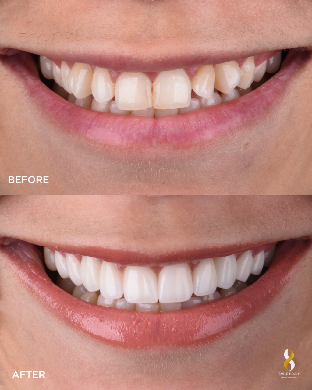 Upper Jaw Treatment Result