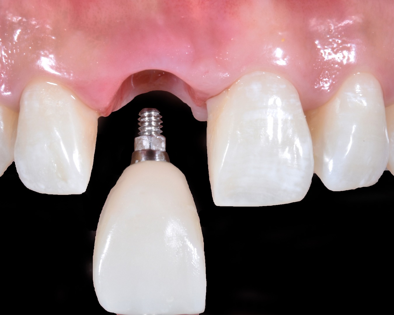 After dental implant treatment at Smile Ready Bali