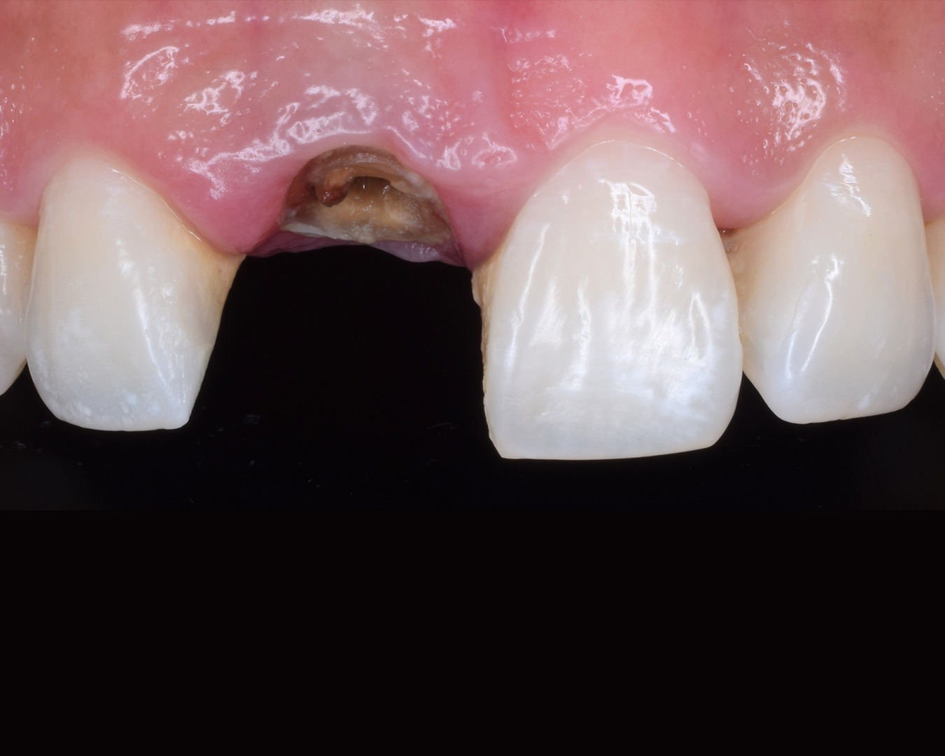 Before dental implant treatment at Smile Ready Bali