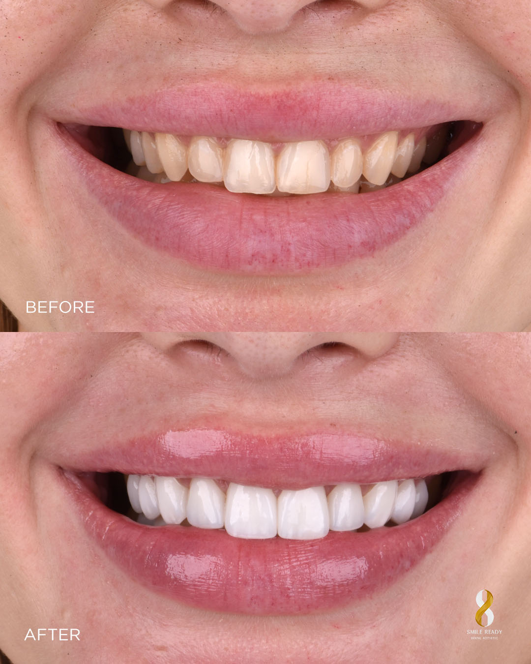 Smile Makeover Standard — before and after, 10 crowns or veneers