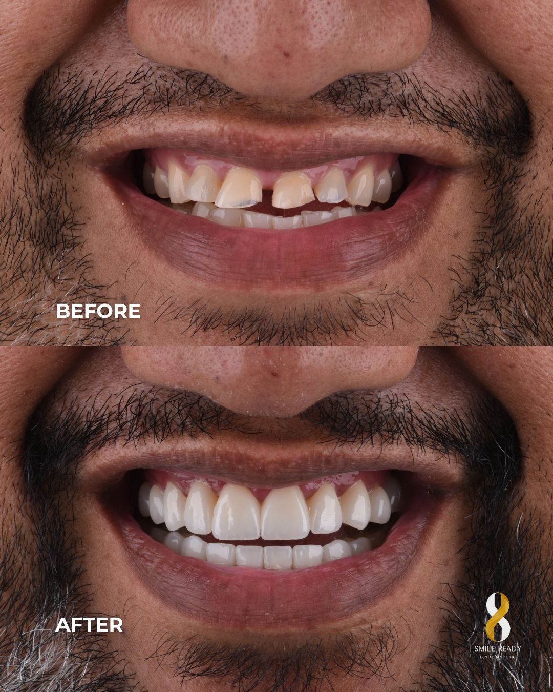 Smile Makeover Best Value — before and after, 20 crowns or veneers